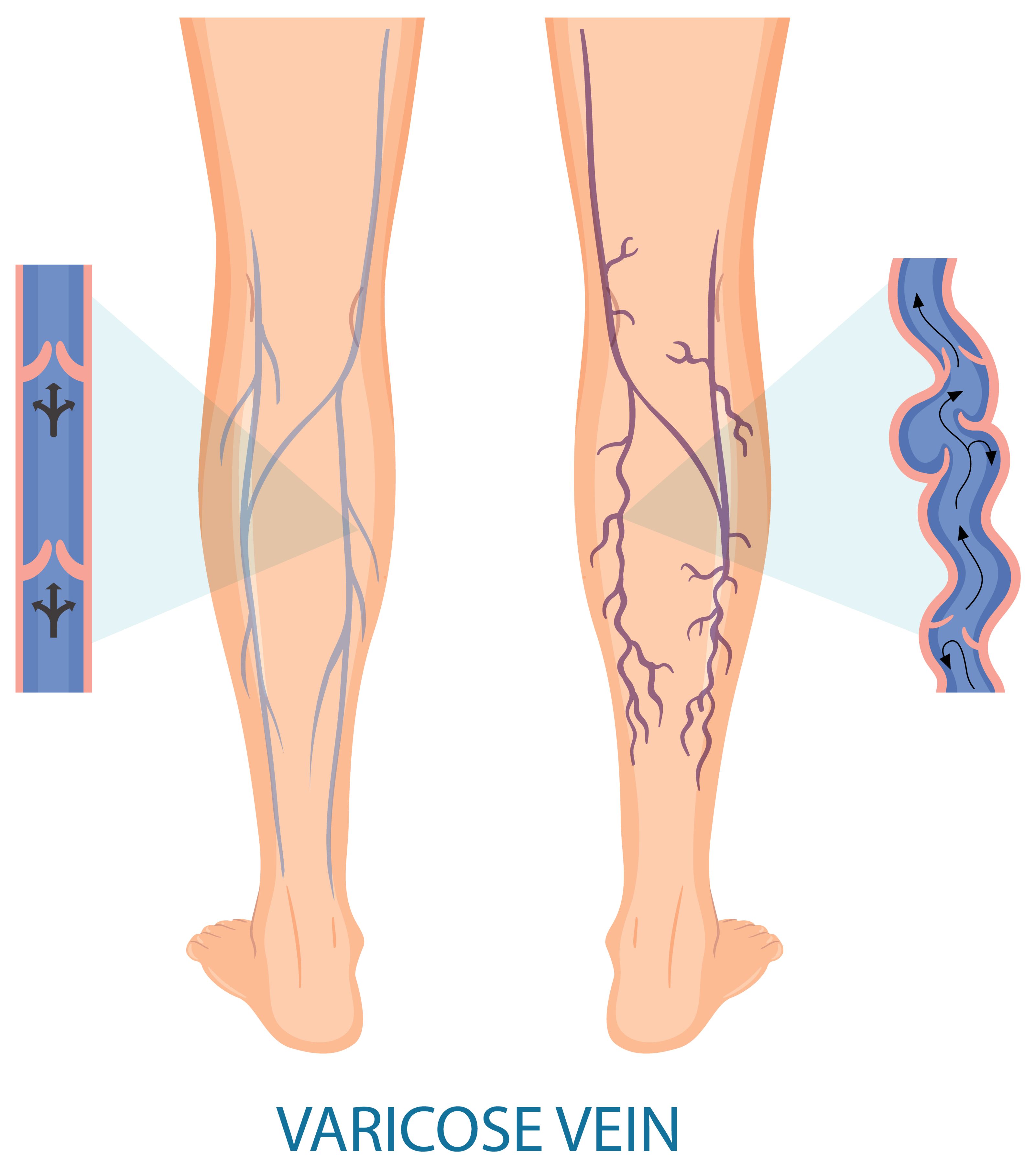 specialist for varicose veins 