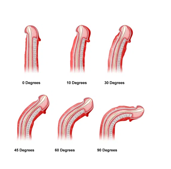 Peyronie’s specialist in Hyderabad