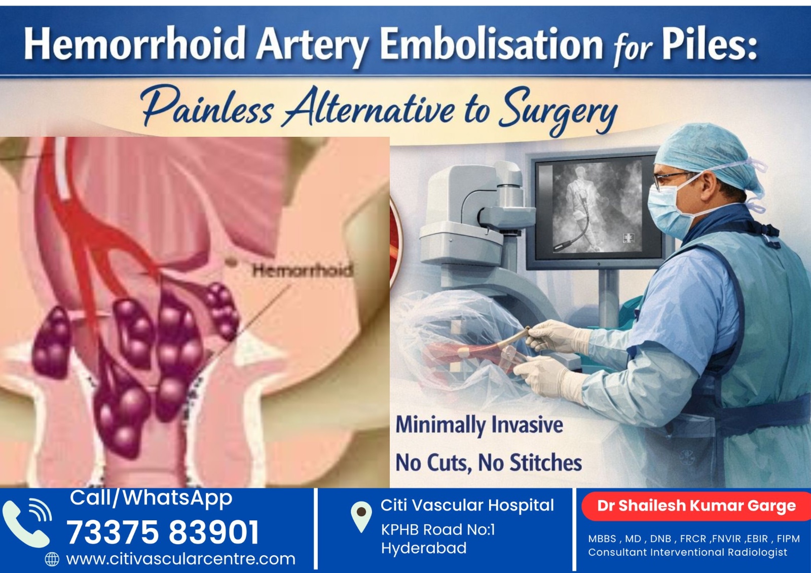 Hemorrhoid Artery Embolisation in Hyderabad