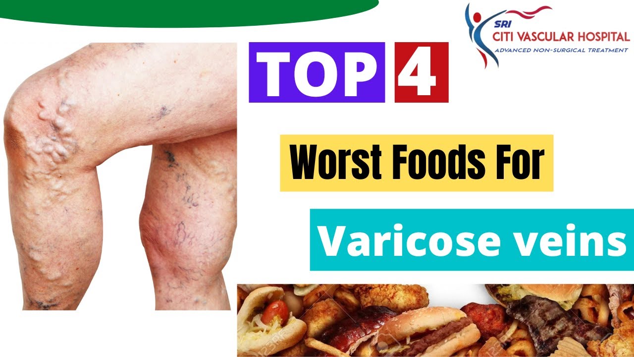 top specialist for vasicose veins in hyderabad
