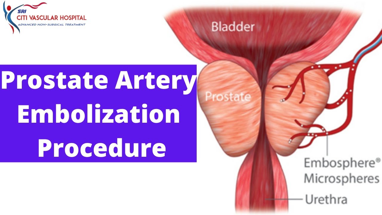 Prostate Artery Embolization  treatment in hyderabad