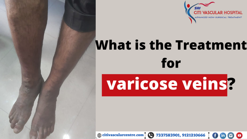 laser treatment for varicose veins in hyderabad 