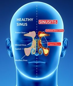 endoscopic sinus surgery cost in hyderabad