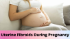 best treatment for fibroids 