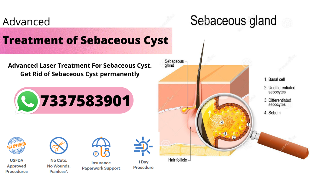 best hospital for sebaceous cyst treatment in hyderabad