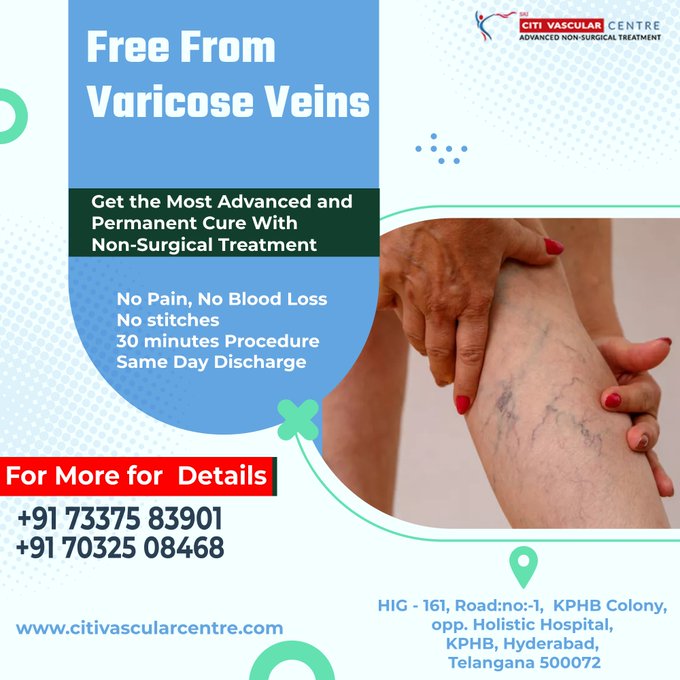 specialist for varicose veins treatment in hyderabad 