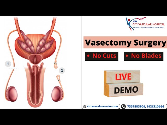 vasectomy treatment at Hyderabad 