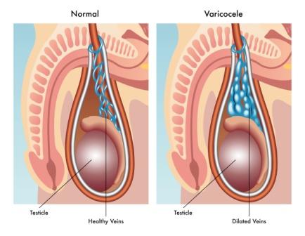 varicocele treatment cost in Hyderabad