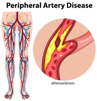 Peripheral Arterial Disease hospital in hyderabad
