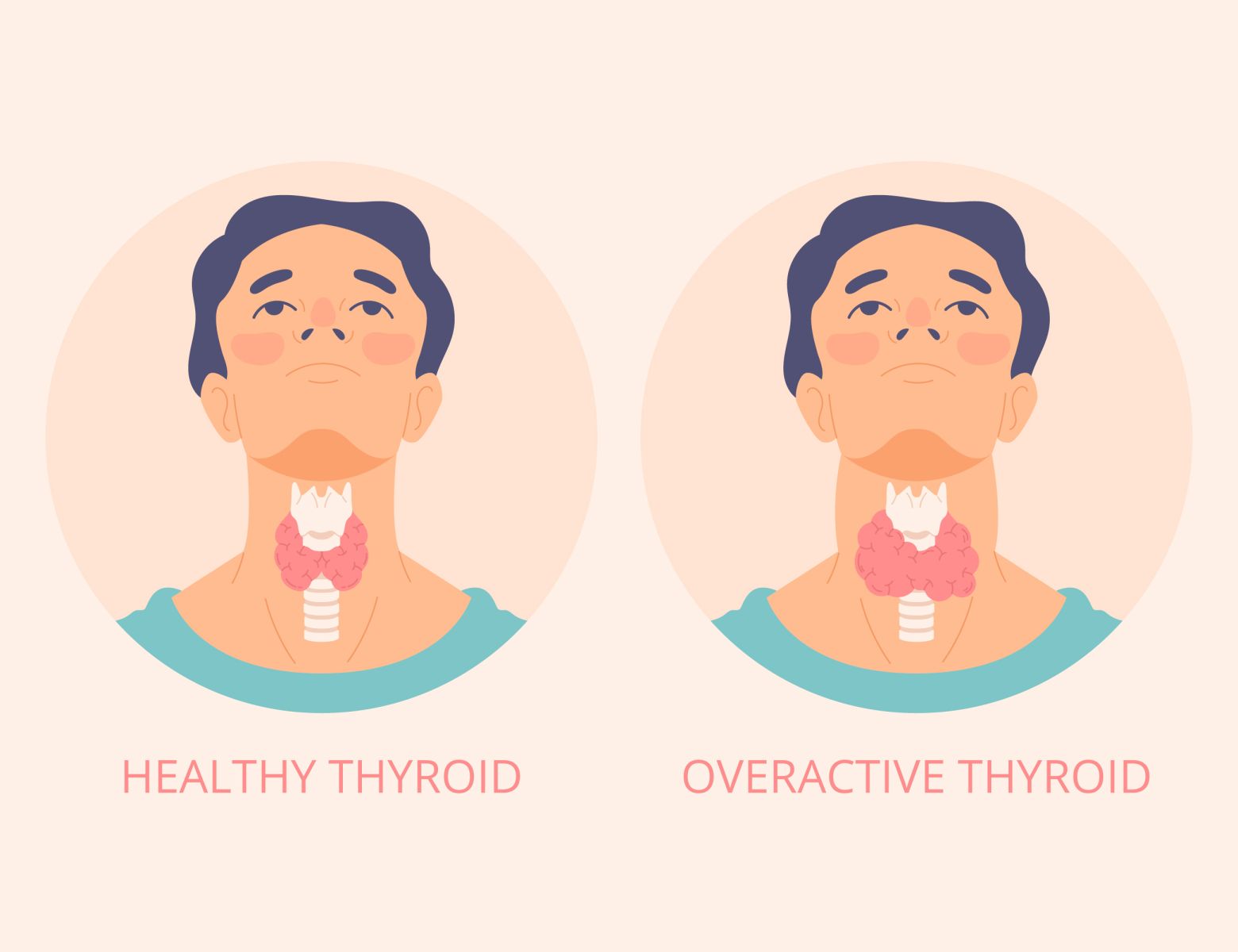 best thyroid treatment in hyderabad