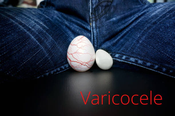 best treatment for varicocele 