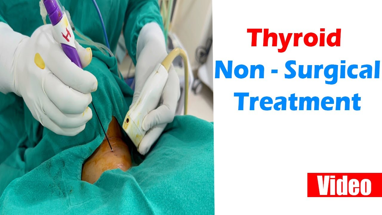 thyroid non-surgical treatment 