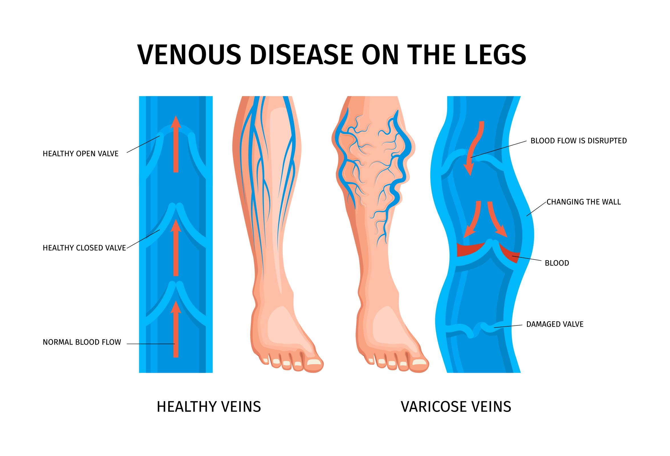 best doctor for varicose veins 