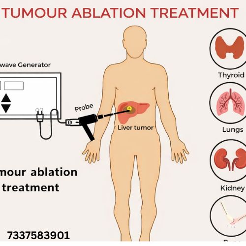 tumor Ablation treatment in hyderabad