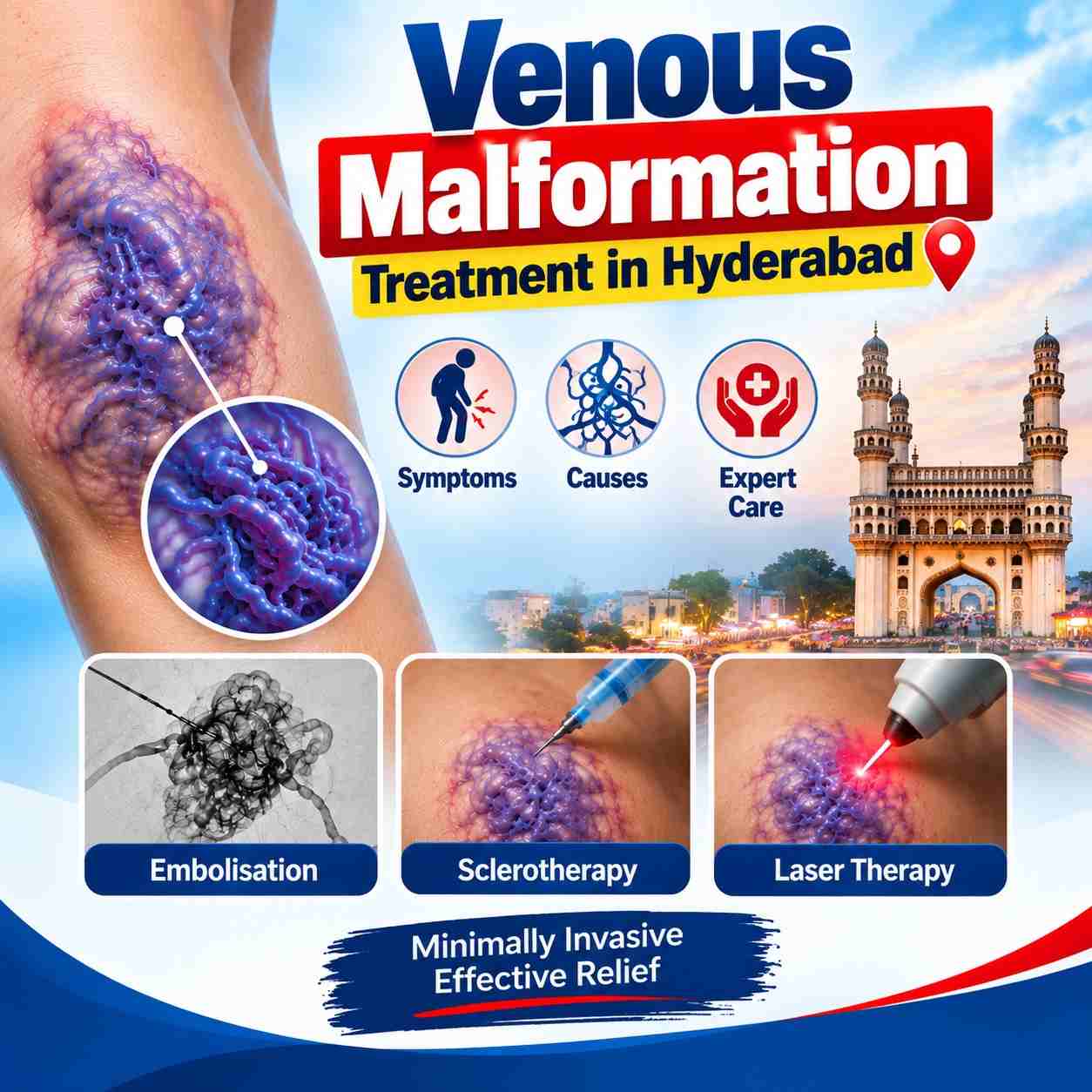 Venous malformation treatment using minimally invasive image-guided vascular intervention , Hyderabad.