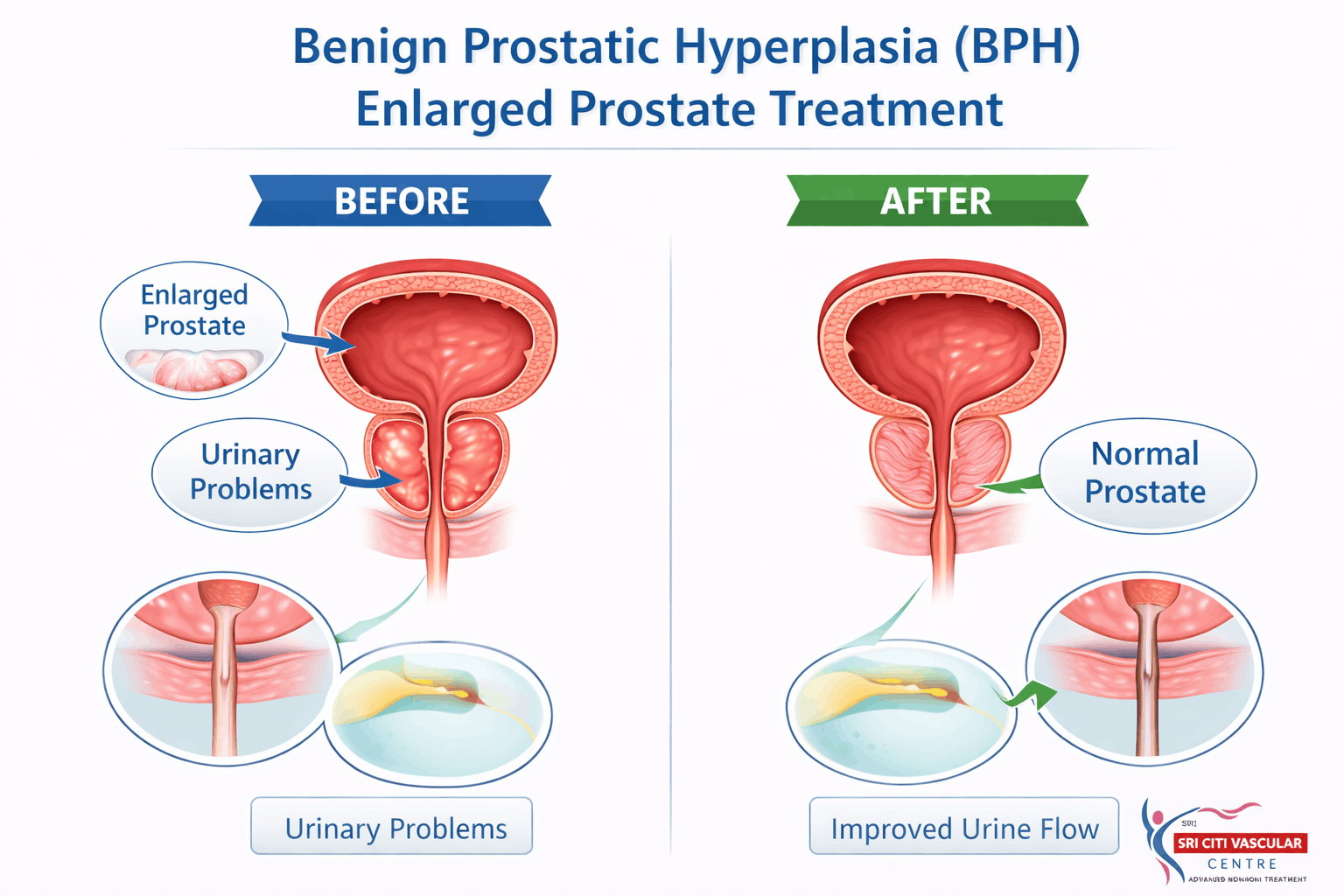 Benign Prostatic Hyperplasia diagram showing enlarged prostate and urinary obstruction