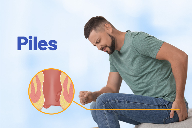Piles embolization treatment in Hyderabad