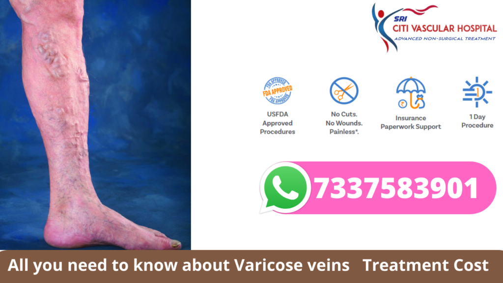 Varicose Veins Treatment Cost in Hyderabad