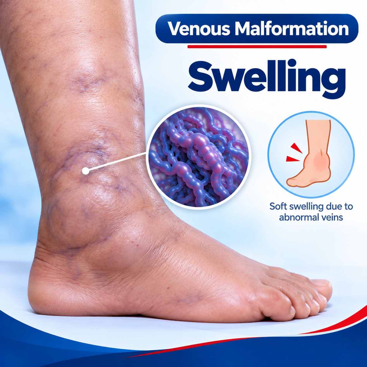 Soft swelling or compressible lump in venous malformation.