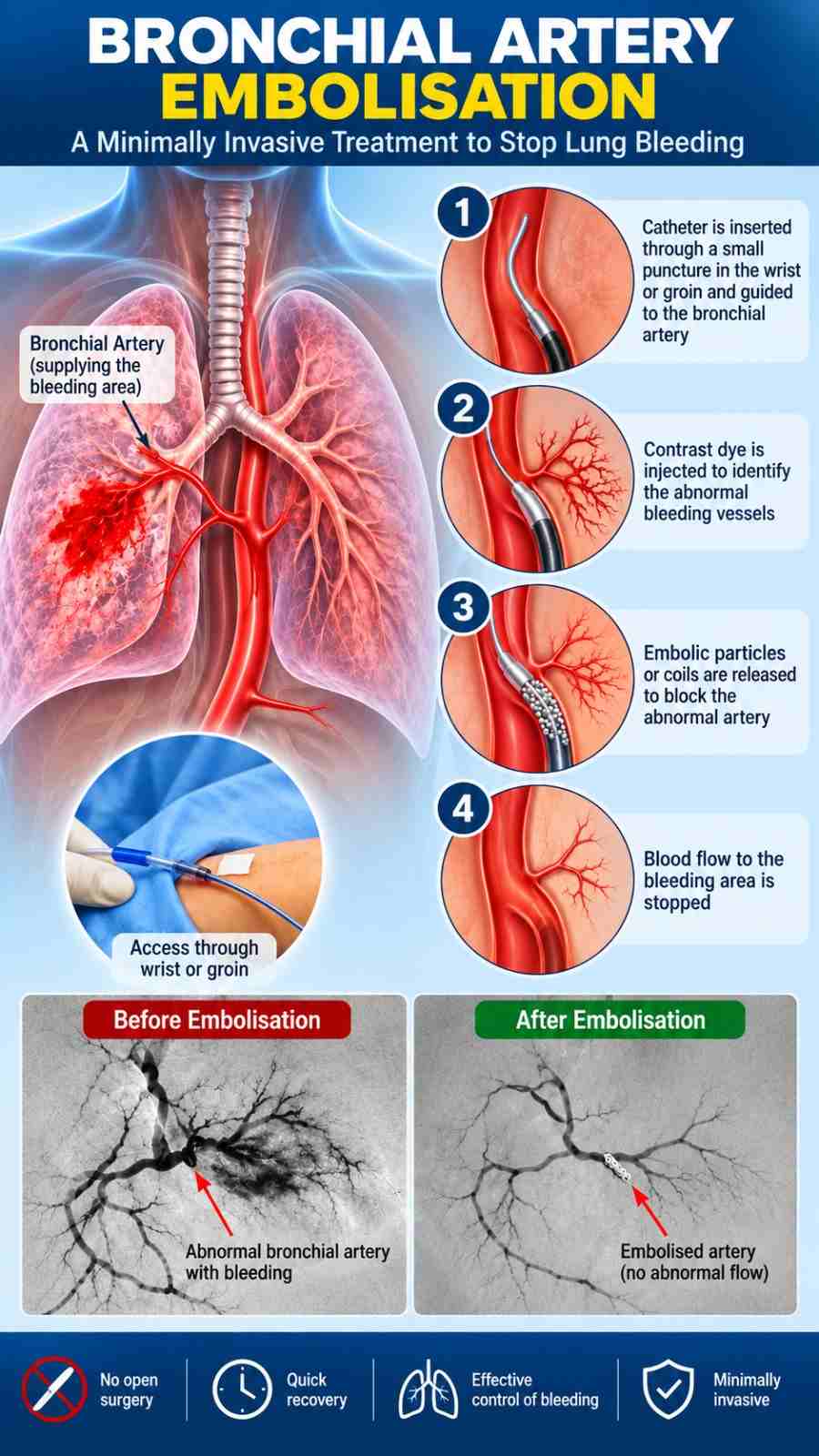 Bronchial Artery Embolisation (BAE) treatment illustration showing catheter-guided embolisation of abnormal bronchial arteries to control bleeding and haemoptysis.