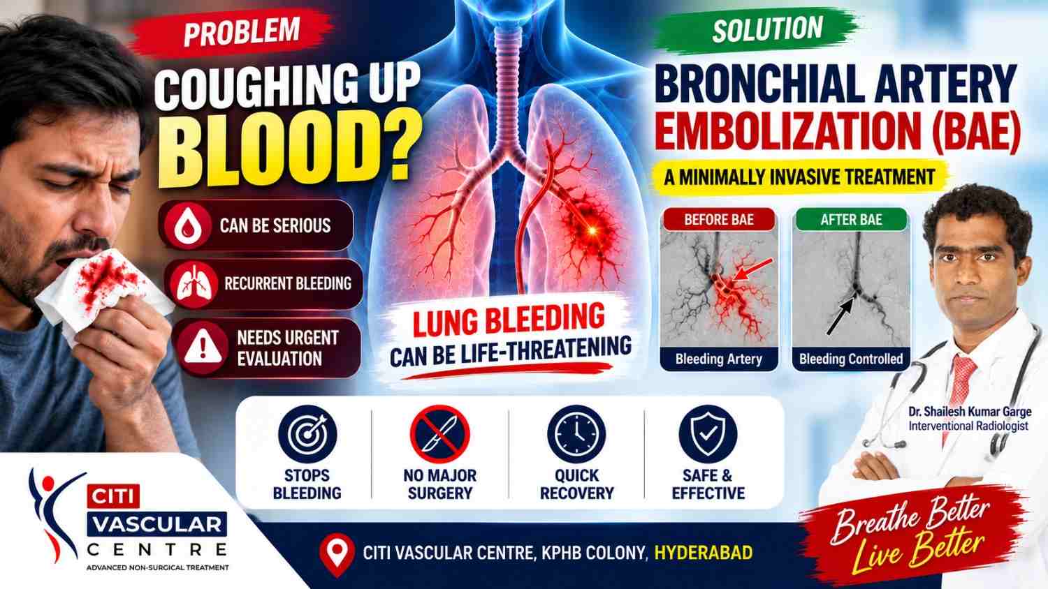 Hemoptysis or coughing up blood treated with bronchial artery embolisation to stop abnormal lung bleeding and help save lives