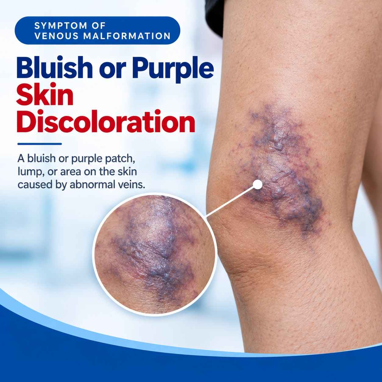 Bluish-purple skin discoloration in venous malformation.