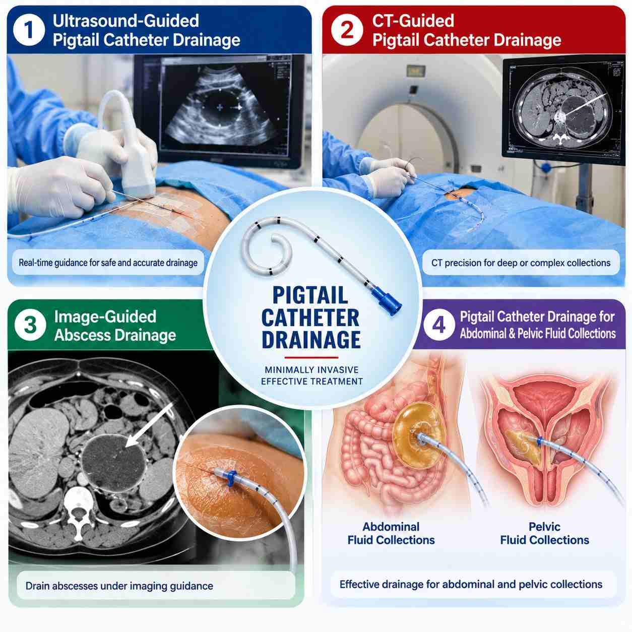Pigtail catheter drainage for various fluid collections and abscesses