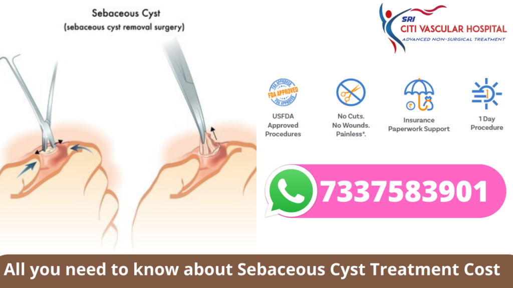 sebaceous cyst removal