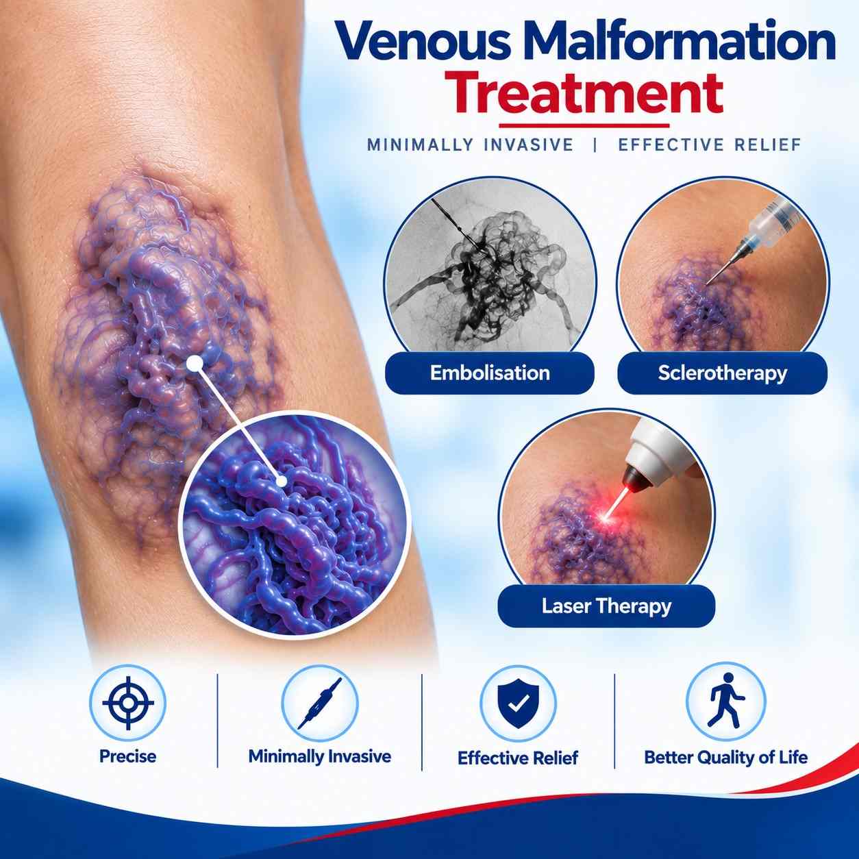 Venous malformation treatments for minimally invasive vascular care.