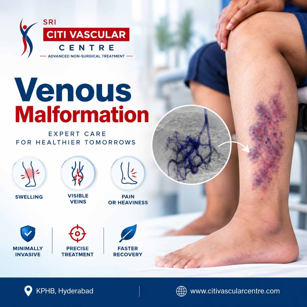 Venous Malformation treatment awareness poster featuring a leg with visible vascular malformation, angiography illustration, and expert vascular care