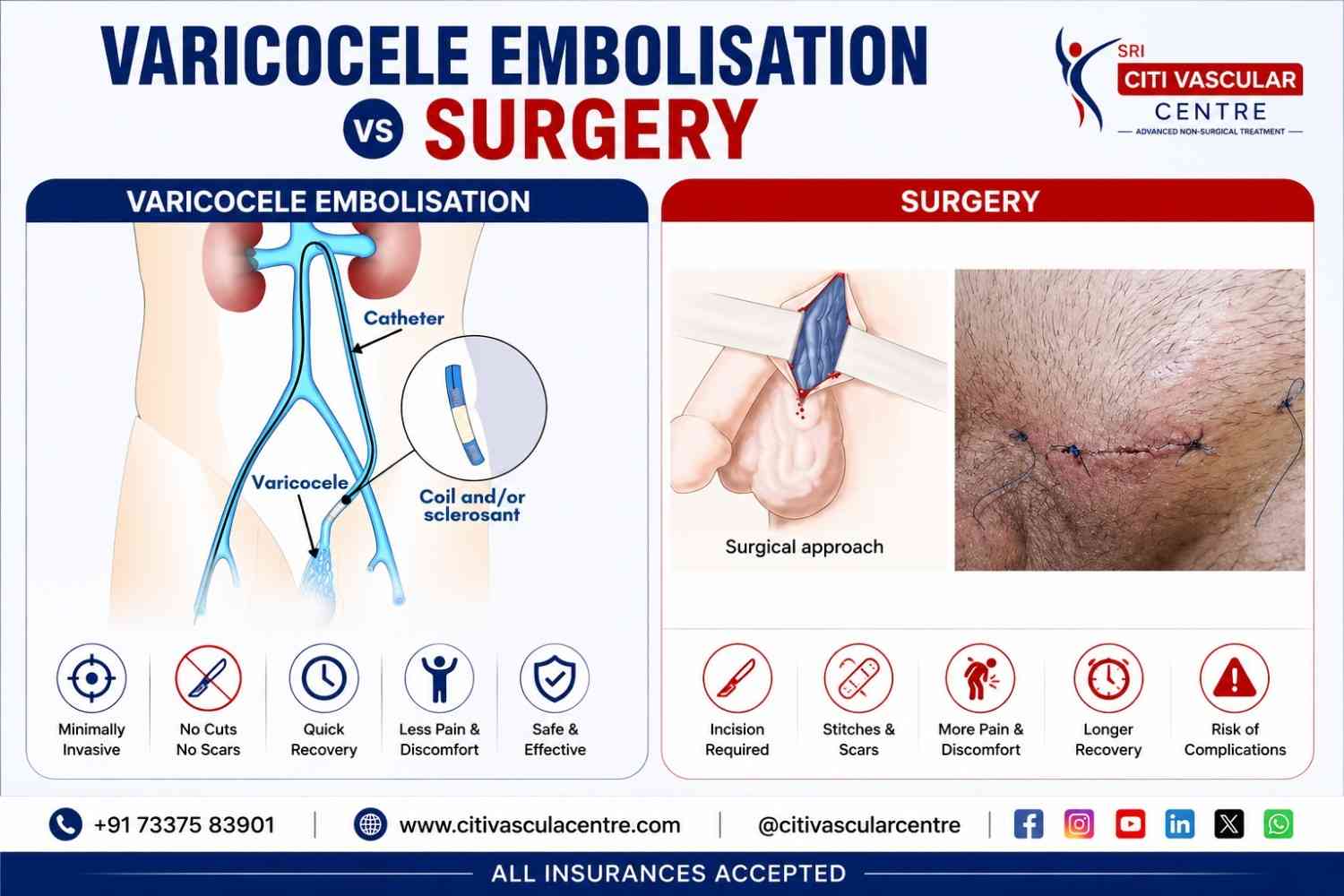 Varicocele surgery vs embolization Hyderabad | Best treatment comparison for varicocele and male infertility