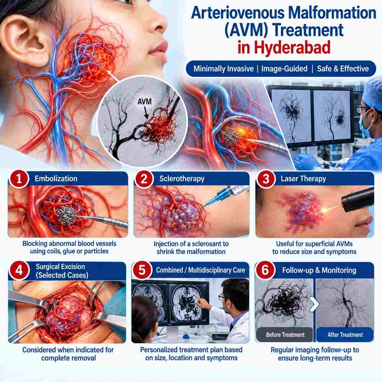 Arteriovenous malformation (AVM) treatment in Hyderabad showing embolization, sclerotherapy, laser therapy, selected surgical excision, multidisciplinary care, and imaging follow-up.